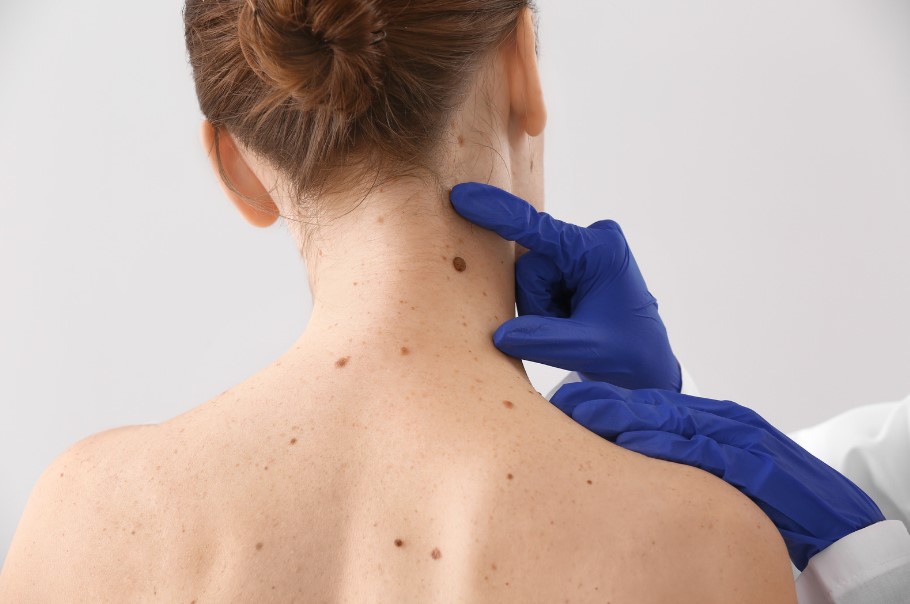 נקודת חן חשודה